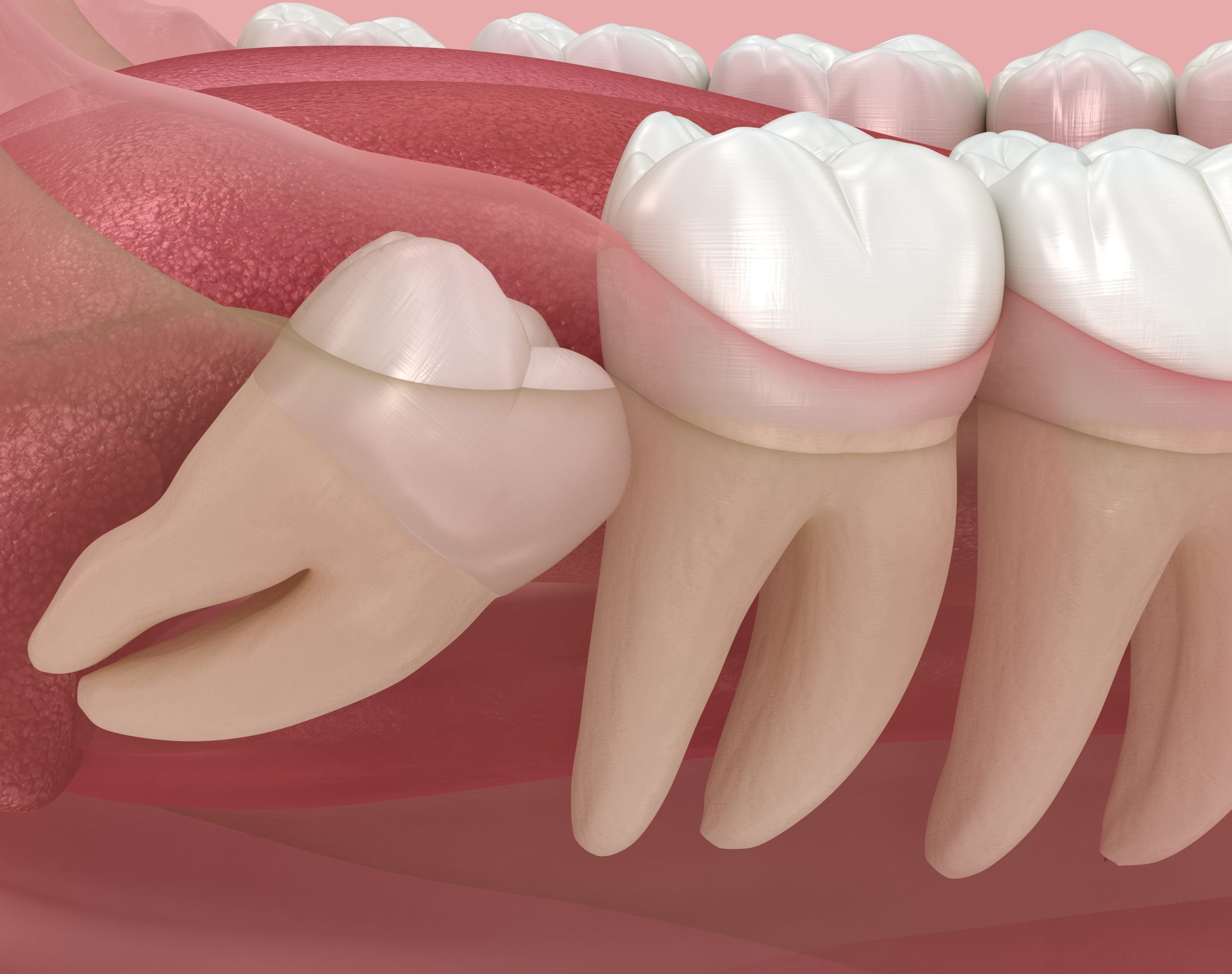 Illustration comparing an upright, partially erupted and horizontally impacted lower wisdom tooth