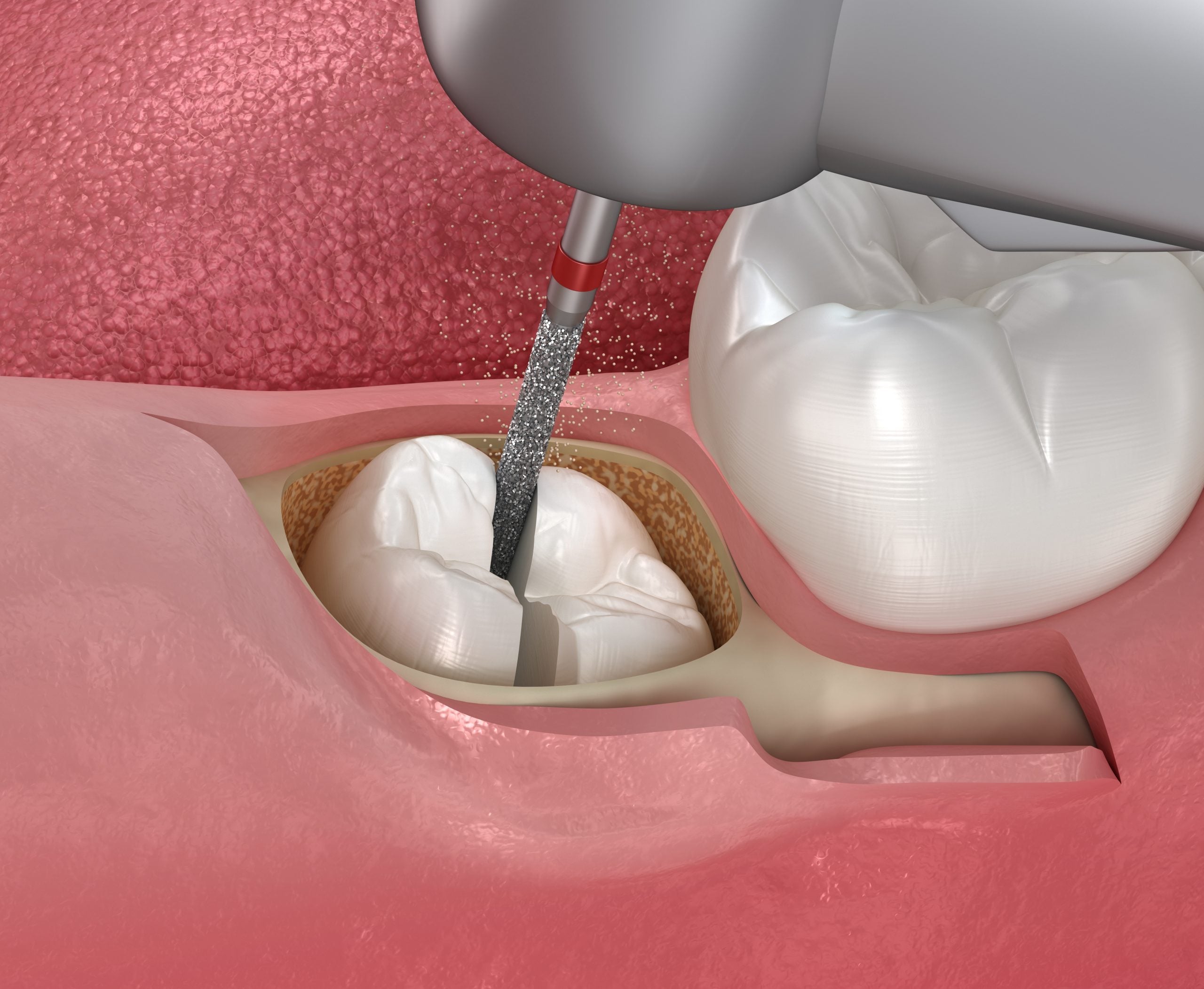 Illustration of wisdom tooth removal