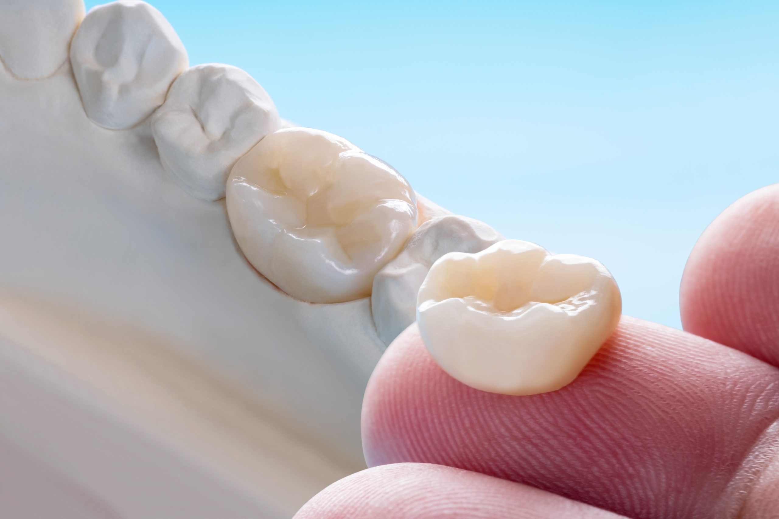 Dental bridge restoration shown on a prosthodontic model