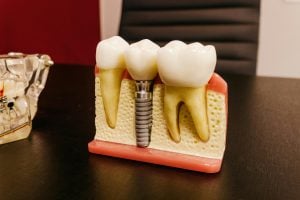 All You Need to Know About Dental Implants in Singapore