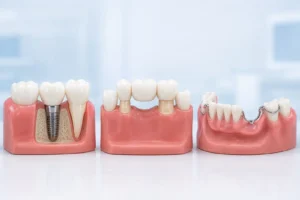 Comparison of a single dental implant crown, a conventional tooth-supported bridge and a removable partial denture